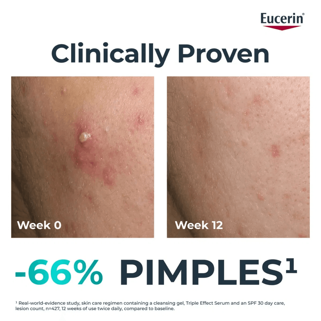 Bí quyết sở hữu làn da sạch mụn, sáng khỏe từ Eucerin! 5 image 39