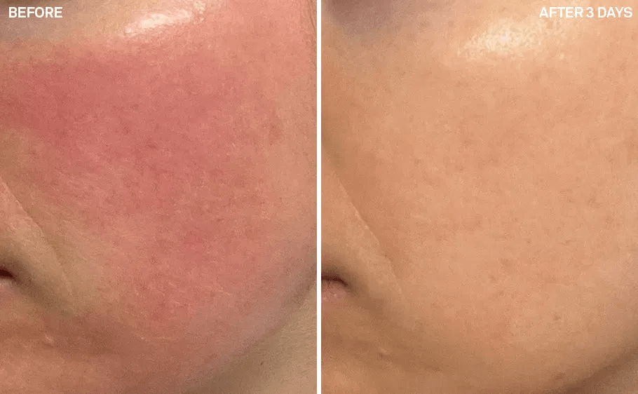 CỨU TINH CHO LÀN DA SAU LASER, PEEL & LĂN KIM - EASYDEW RX POST-LASER WATERFUL SOOTHING CREAM 5 image 64